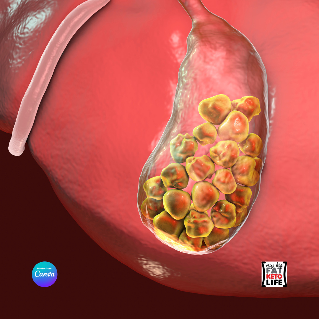 Πως να κάνετε κετογονική διατροφή χωρίς χοληδόχο κύστη